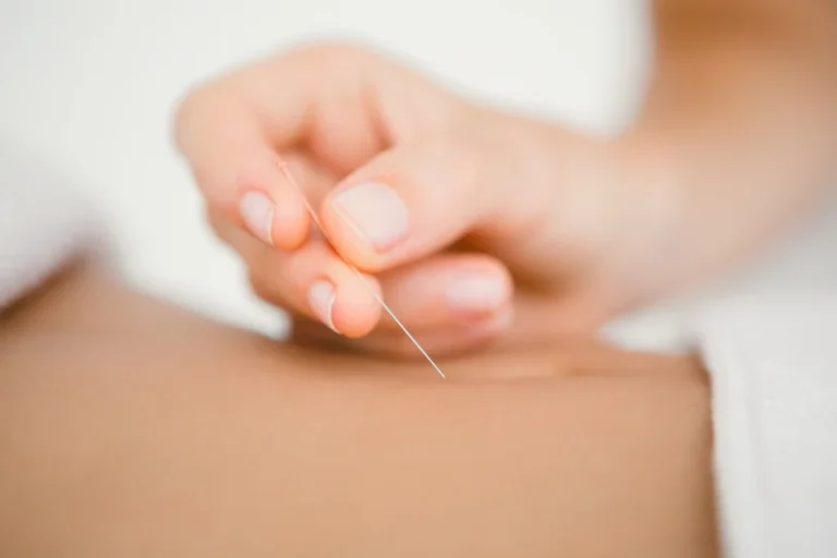 Akupunktur - Schmerztherapie